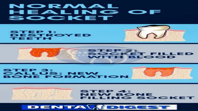 how quickly does dry socket pain set in 1 how quickly does dry socket pain set in